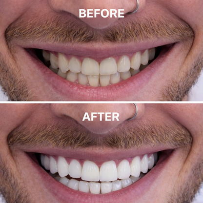 Enamel-Safe Teeth Whitening Strips (Gen 2 Purple Formula)